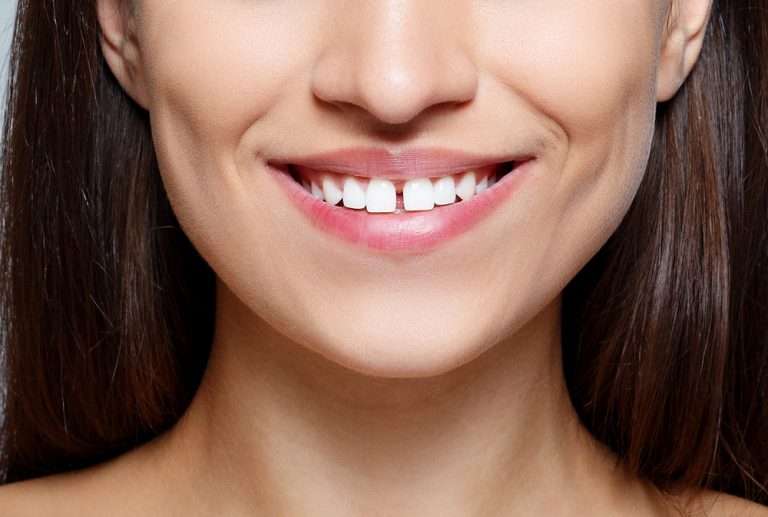 Gapped teeth at Premier Family Dental Care