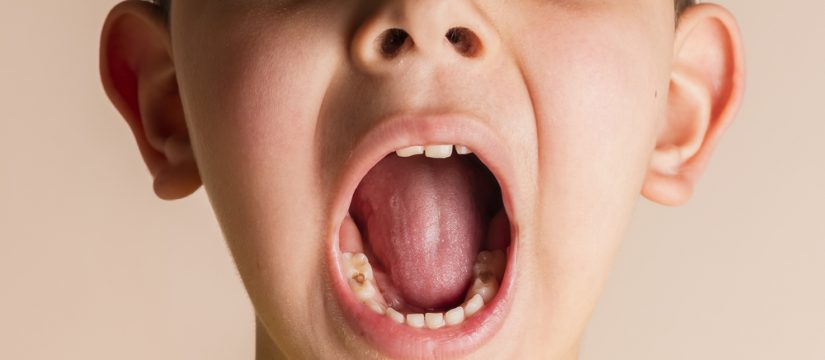 Kids' Dentist Answers: What is Baby Bottle Tooth Decay? - Smiles Dentistry  4 Kids