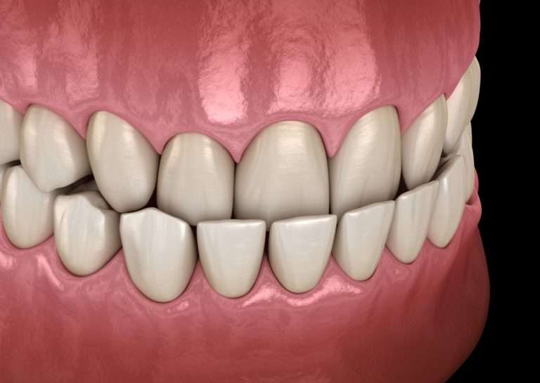 Causes, treatment and questions about underbite