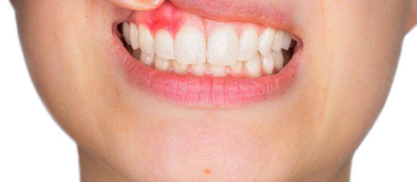 Home Remedies For Tooth Gum Abscess Volume 1 Gilbert Dentist   Home Remedies For Tooth Or Gum Abscess 825x360 