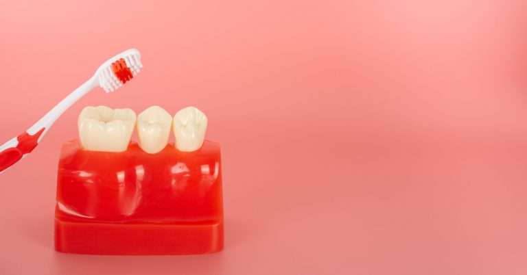 Care after dental implants