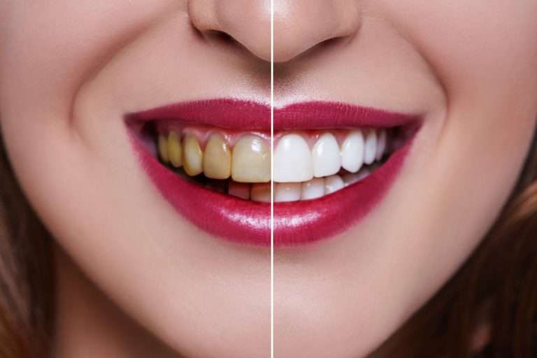 dental veneers - pros and cons