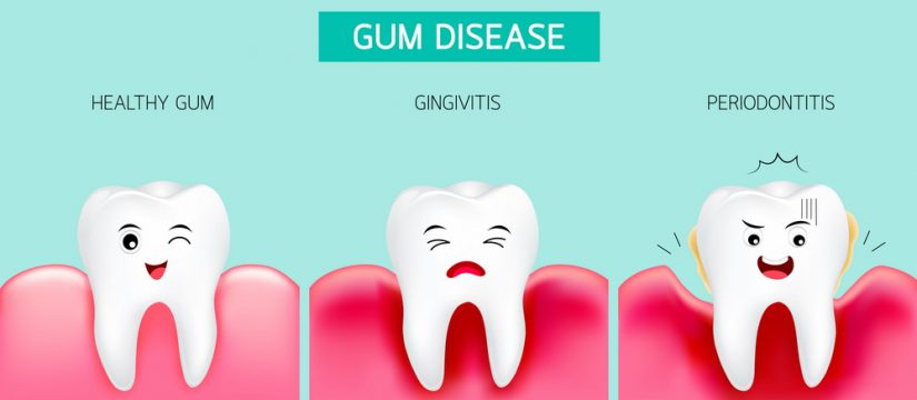 Don't just brush off bleeding gums! Bleeding gums can be a sign of gum  disease which can lead to serious consequences such as losing your…