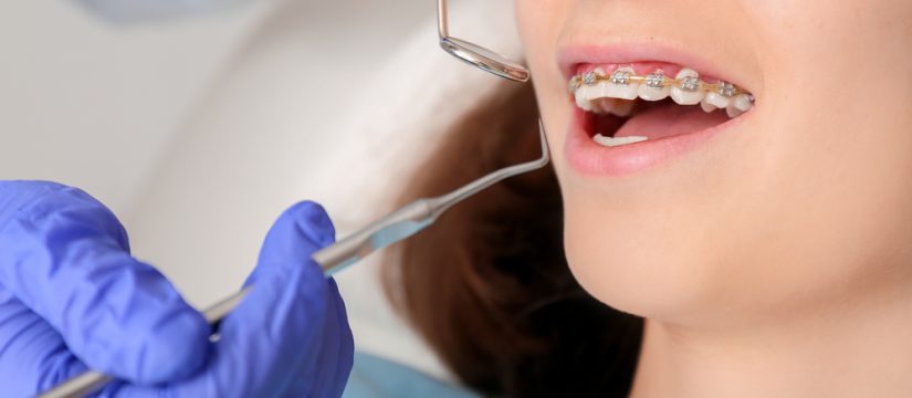 Braces and discoloration - How to fix it? - Gilbert Dentist