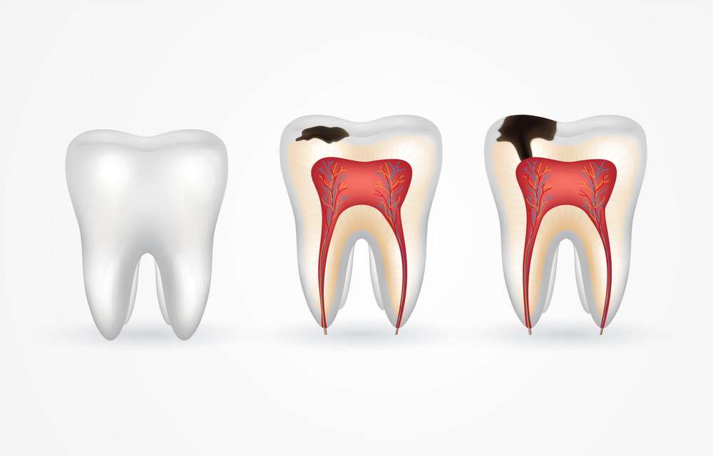 tooth decay