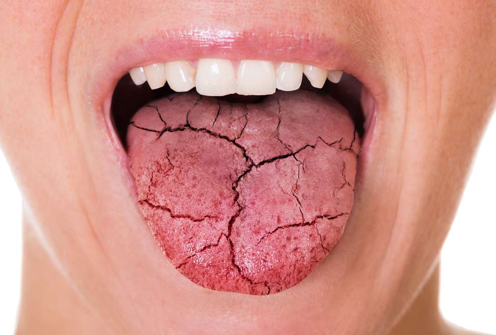 dry mouth - reasons and solutions