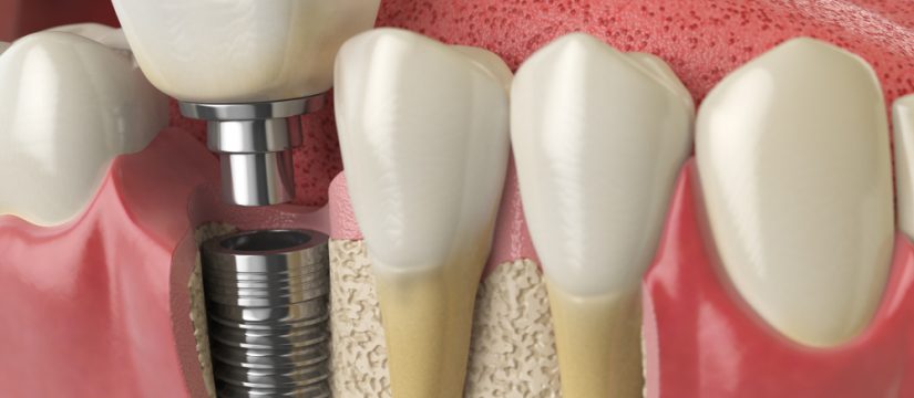 dental implant failure
