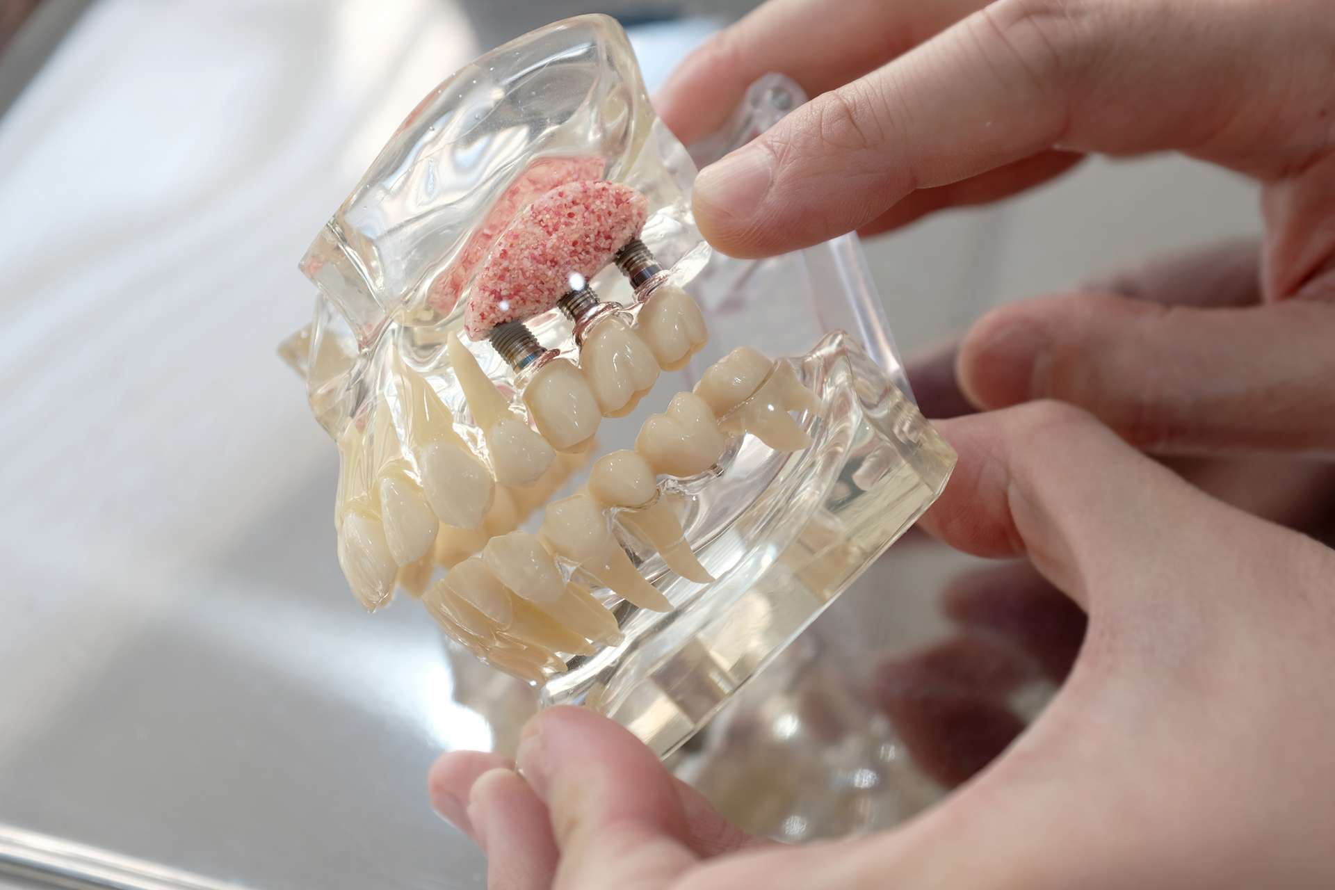 Hands holding a clear dental model showing dental implants and artificial teeth, with a pink gum section and metal posts illustrating how dental implants are placed in the upper jaw.